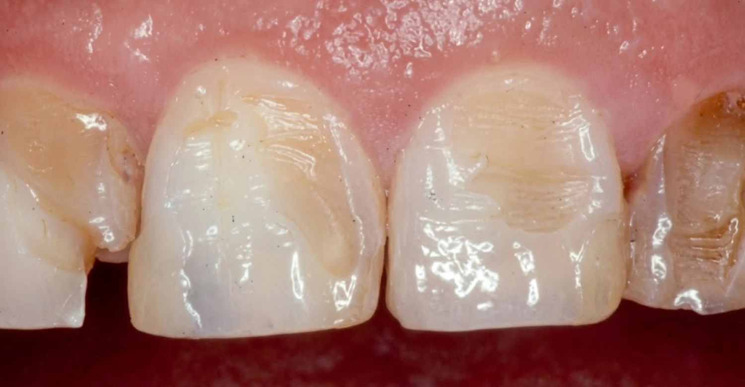 Tooth Enamel Erosion Inblog